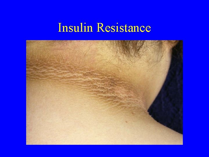 Insulin Resistance 