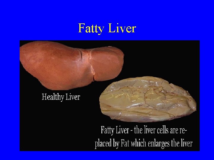 Fatty Liver 