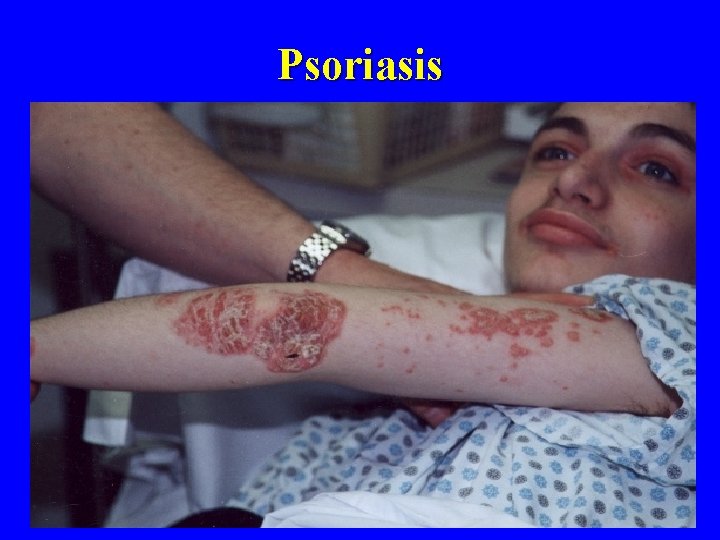 Psoriasis 