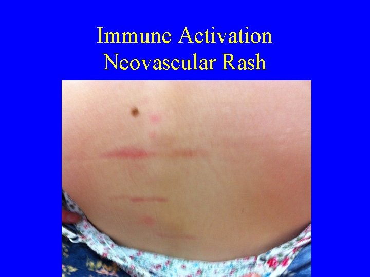 Immune Activation Neovascular Rash 