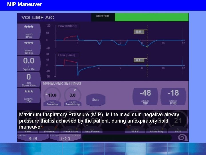 MIP Maneuver Maximum Inspiratory Pressure (MIP), is the maximum negative airway pressure that is