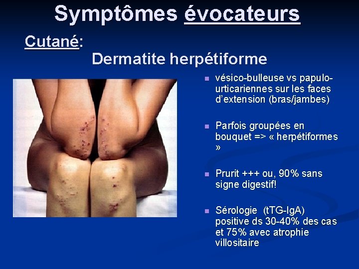 Symptômes évocateurs Cutané: Dermatite herpétiforme n vésico-bulleuse vs papulourticariennes sur les faces d’extension (bras/jambes)