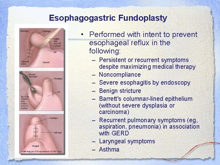 Esophagogastric Fundoplasty • Performed with intent to prevent esophageal reflux in the following: –