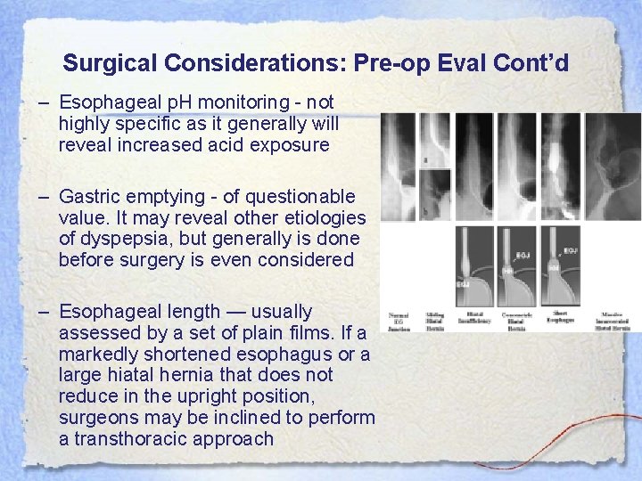 Surgical Considerations: Pre-op Eval Cont’d – Esophageal p. H monitoring - not highly specific