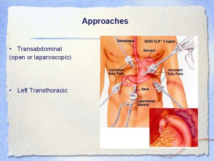 Approaches • Transabdominal (open or laparoscopic) • Left Transthoracic 
