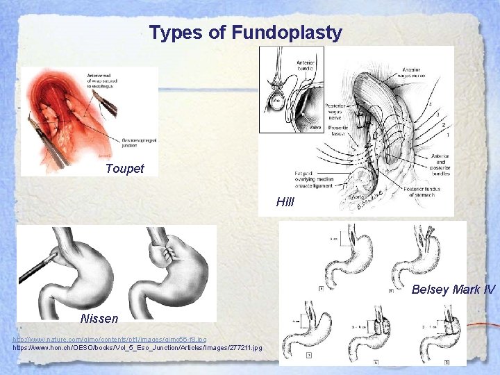 Types of Fundoplasty Toupet Hill Belsey Mark IV Nissen http: //www. nature. com/gimo/contents/pt 1/images/gimo
