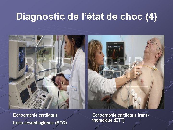 Diagnostic de l’état de choc (4) Echographie cardiaque trans-oesophagienne (ETO) Echographie cardiaque transthoracique (ETT)