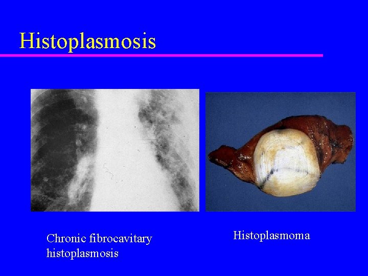 Histoplasmosis Chronic fibrocavitary histoplasmosis Histoplasmoma 