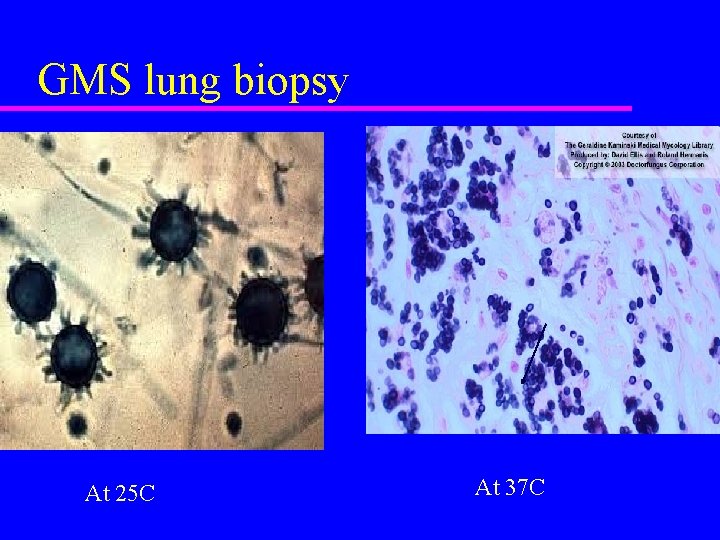 GMS lung biopsy At 25 C At 37 C 