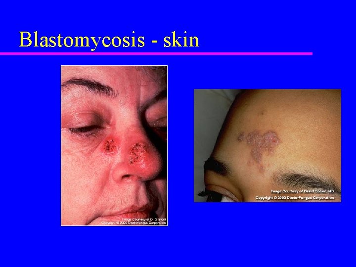 Blastomycosis - skin 