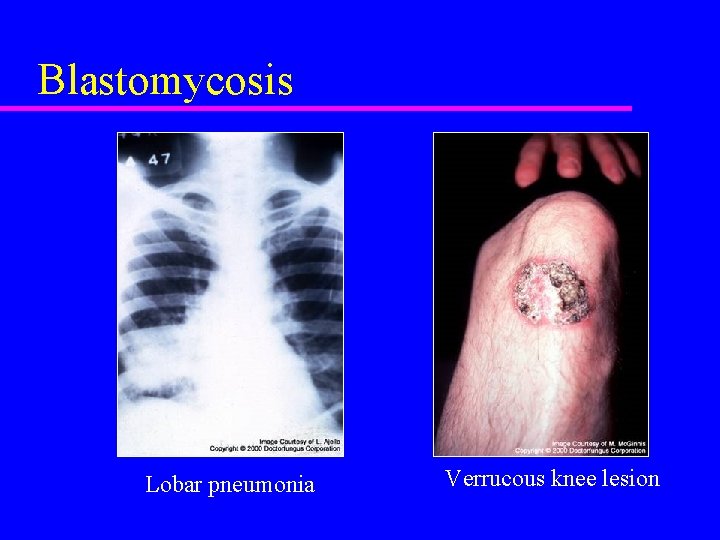 Blastomycosis Lobar pneumonia Verrucous knee lesion 