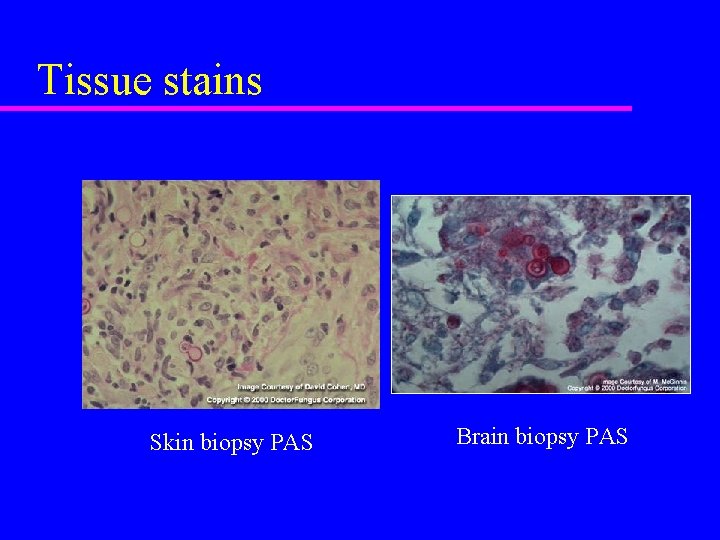 Tissue stains Skin biopsy PAS Brain biopsy PAS 