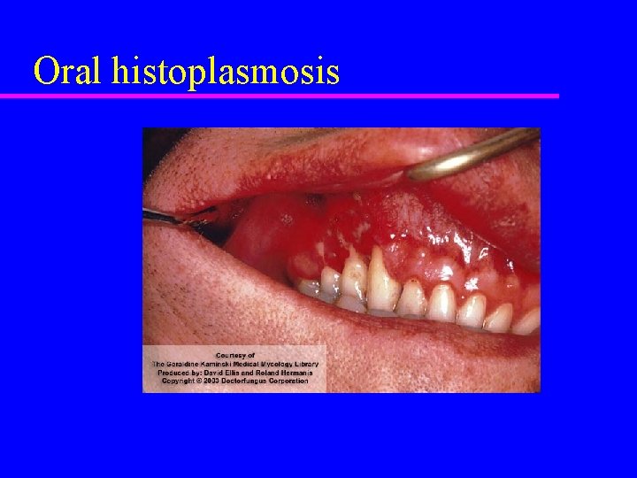 Oral histoplasmosis 