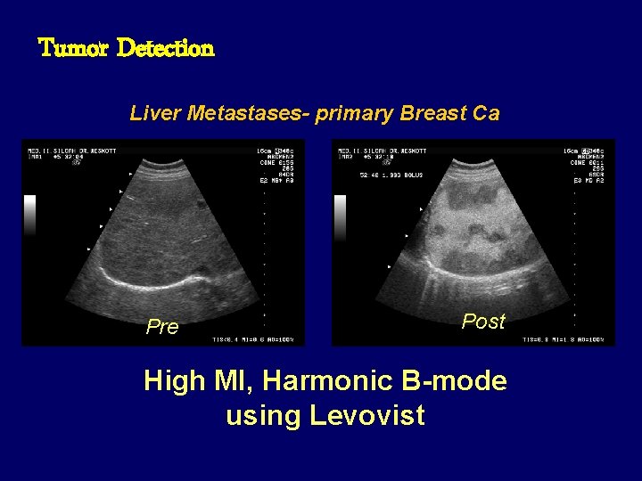 Tumor Detection Liver Metastases- primary Breast Ca Pre Post High MI, Harmonic B-mode using