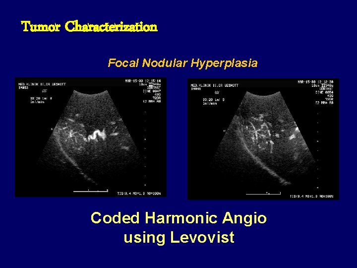Tumor Characterization Focal Nodular Hyperplasia Coded Harmonic Angio using Levovist 