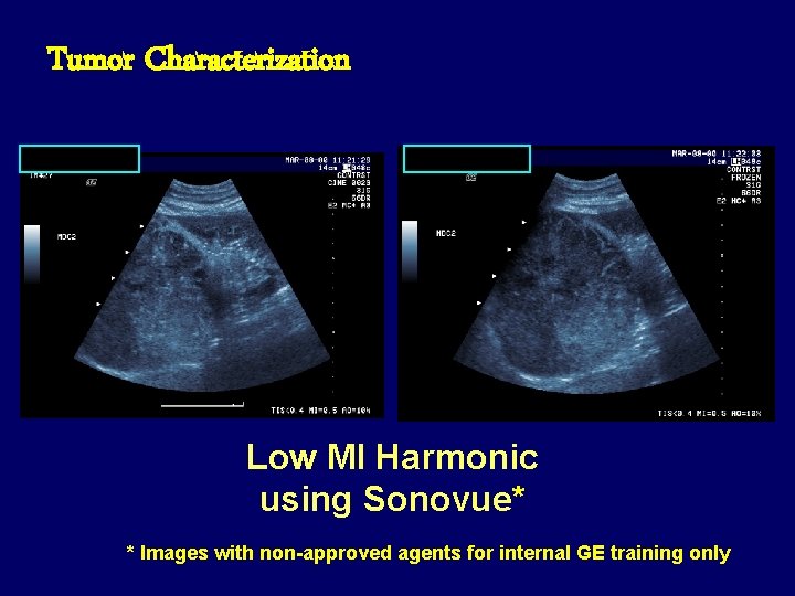 Tumor Characterization Low MI Harmonic using Sonovue* * Images with non-approved agents for internal