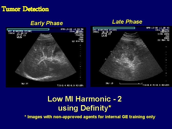 Tumor Detection Early Phase Late Phase Low MI Harmonic - 2 using Definity* *
