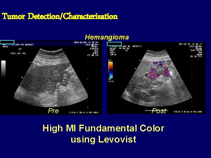 Tumor Detection/Characterization Hemangioma Pre Post High MI Fundamental Color using Levovist 