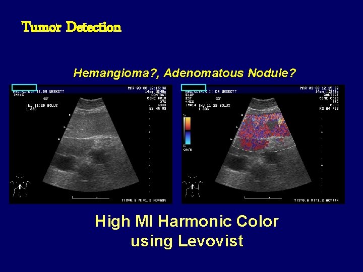 Tumor Detection Hemangioma? , Adenomatous Nodule? High MI Harmonic Color using Levovist 