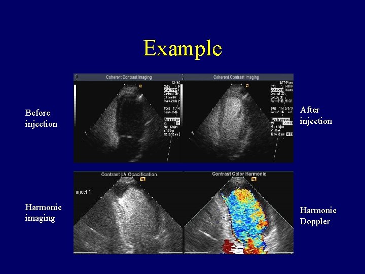 Example Before injection After injection Harmonic imaging Harmonic Doppler 