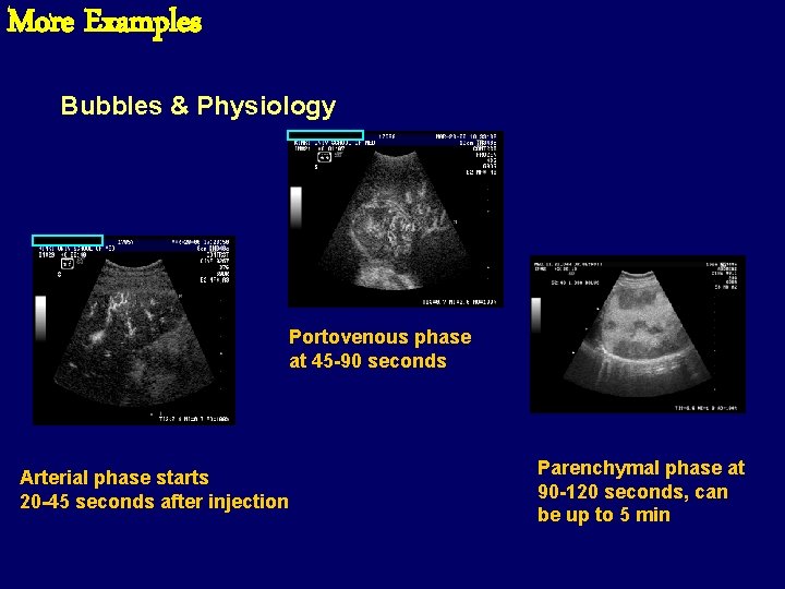 More Examples Bubbles & Physiology Portovenous phase at 45 -90 seconds Arterial phase starts