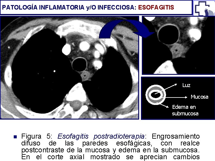 PATOLOGÍA INFLAMATORIA y/O INFECCIOSA: ESOFAGITIS Luz Mucosa Edema en submucosa n Figura 5: Esofagitis