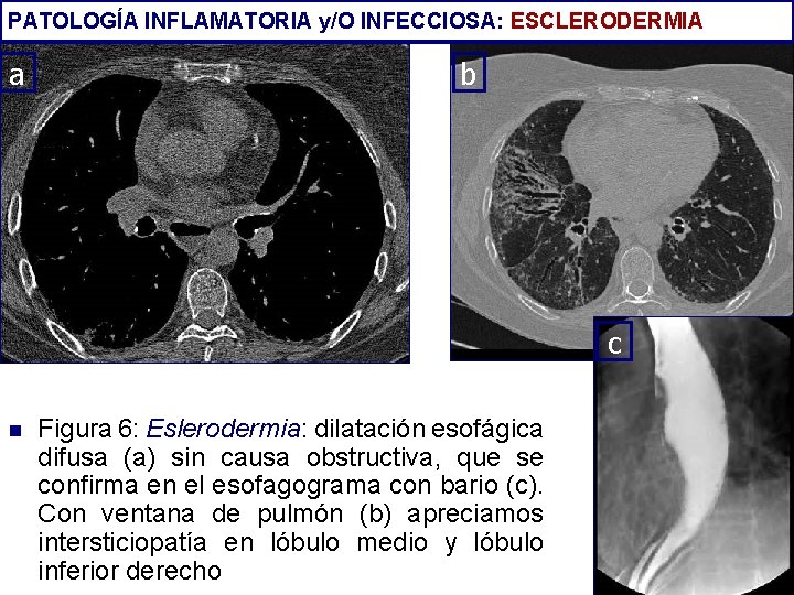 PATOLOGÍA INFLAMATORIA y/O INFECCIOSA: ESCLERODERMIA a b c n Figura 6: Eslerodermia: dilatación esofágica