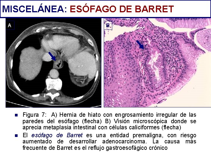 MISCELÁNEA: ESÓFAGO DE BARRET A B n n Figura 7: A) Hernia de hiato