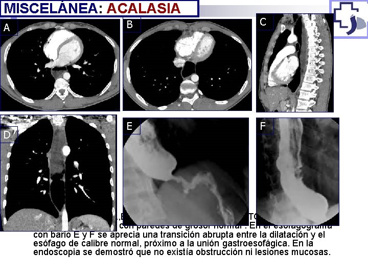 MISCELÁNEA: ACALASIA A D n B C E F Figura 8: Acalasia: A, B,