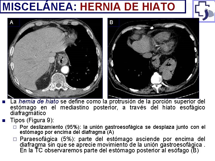 MISCELÁNEA: HERNIA DE HIATO A n n B La hernia de hiato se define