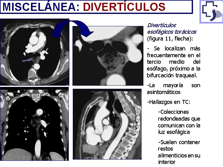 MISCELÁNEA: DIVERTÍCULOS Divertículos esofágicos torácicos (figura 11, flecha): - Se localizan más frecuentemente en