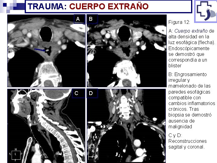 TRAUMA: CUERPO EXTRAÑO A B Figura 12: A: Cuerpo extraño de alta densidad en