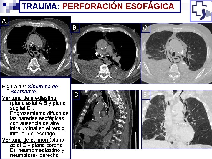 TRAUMA: PERFORACIÓN ESOFÁGICA A Figura 13: Síndrome de Boerhaave: Ventana de mediastino (plano axial