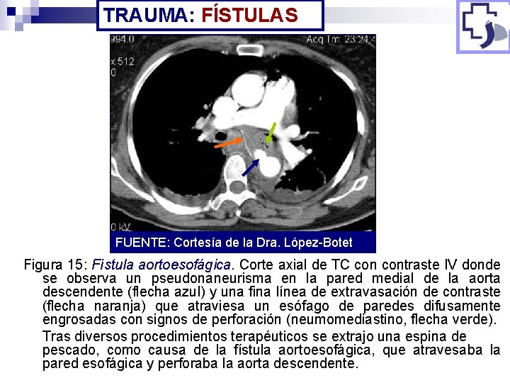 TRAUMA: FÍSTULAS FUENTE: Cortesía de la Dra. López-Botet Figura 15: Fístula aortoesofágica. Corte axial