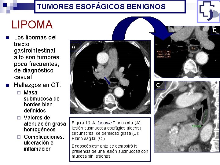 TUMORES ESOFÁGICOS BENIGNOS LIPOMA n n Los lipomas del tracto gastrointestinal alto son tumores