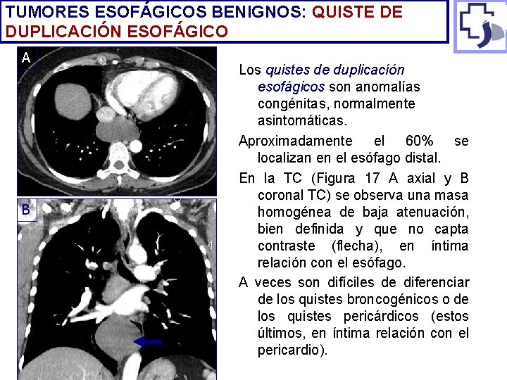 TUMORES ESOFÁGICOS BENIGNOS: QUISTE DE DUPLICACIÓN ESOFÁGICO A B Los quistes de duplicacíón esofágicos