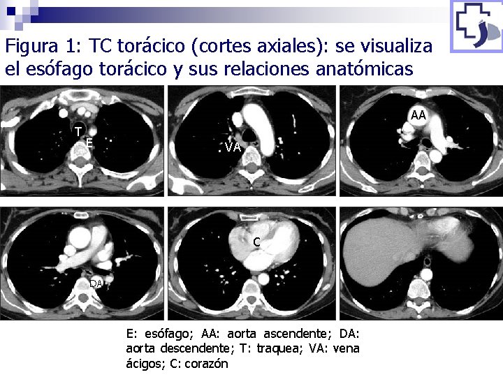 Figura 1: TC torácico (cortes axiales): se visualiza el esófago torácico y sus relaciones