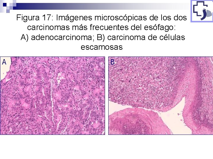 Figura 17: Imágenes microscópicas de los dos carcinomas más frecuentes del esófago: A) adenocarcinoma;