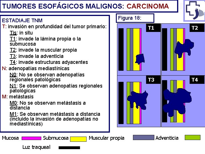 TUMORES ESOFÁGICOS MALIGNOS: CARCINOMA ESTADIAJE TNM T: invasión en profundidad del tumor primario: Tis: