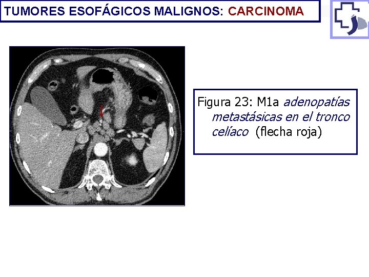 TUMORES ESOFÁGICOS MALIGNOS: CARCINOMA Figura 23: M 1 a adenopatías metastásicas en el tronco