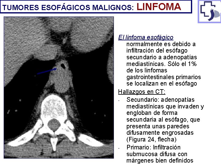 TUMORES ESOFÁGICOS MALIGNOS: LINFOMA El linfoma esofágico normalmente es debido a infiltración del esófago