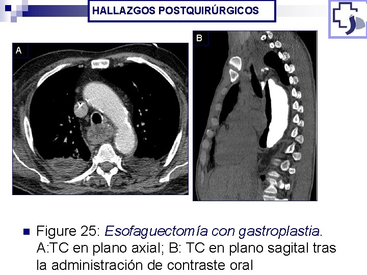 HALLAZGOS POSTQUIRÚRGICOS B A n Figure 25: Esofaguectomía con gastroplastia. A: TC en plano