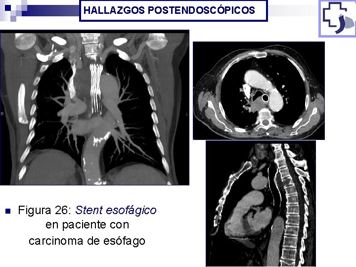 HALLAZGOS POSTENDOSCÓPICOS n Figura 26: Stent esofágico en paciente con carcinoma de esófago 