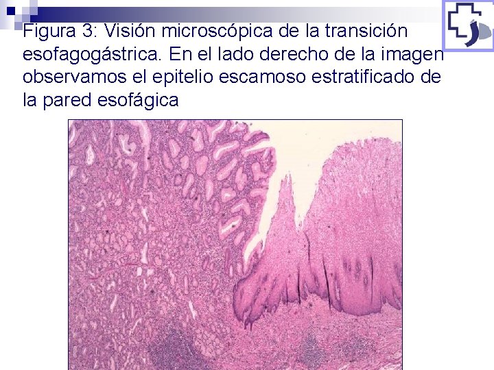 Figura 3: Visión microscópica de la transición esofagogástrica. En el lado derecho de la
