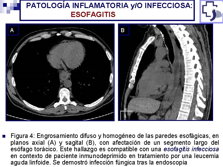 PATOLOGÍA INFLAMATORIA y/O INFECCIOSA: ESOFAGITIS A n B Figura 4: Engrosamiento difuso y homogéneo