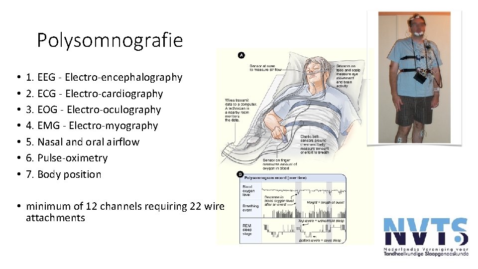 Polysomnografie • • 1. EEG - Electro-encephalography 2. ECG - Electro-cardiography 3. EOG - Polysomnografie • • 1. EEG - Electro-encephalography 2. ECG - Electro-cardiography 3. EOG -