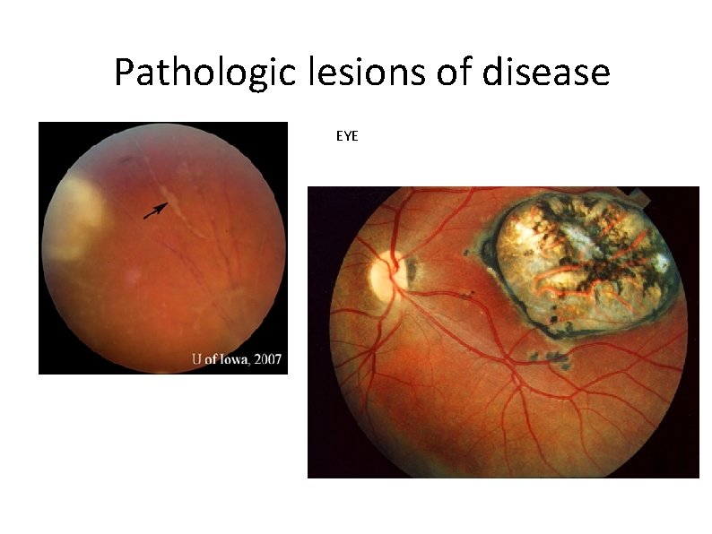 Pathologic lesions of disease EYE 