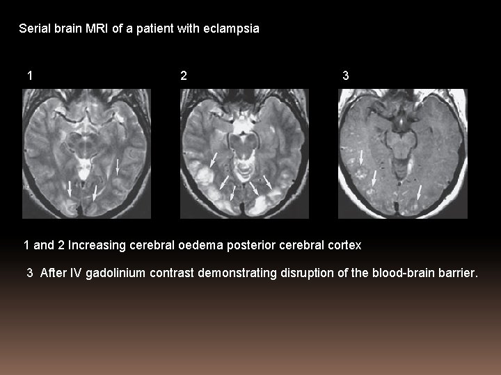 Serial brain MRI of a patient with eclampsia 1 2 3 1 and 2