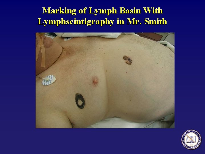 Marking of Lymph Basin With Lymphscintigraphy in Mr. Smith 