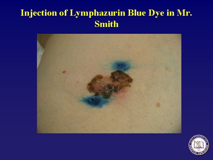 Injection of Lymphazurin Blue Dye in Mr. Smith 